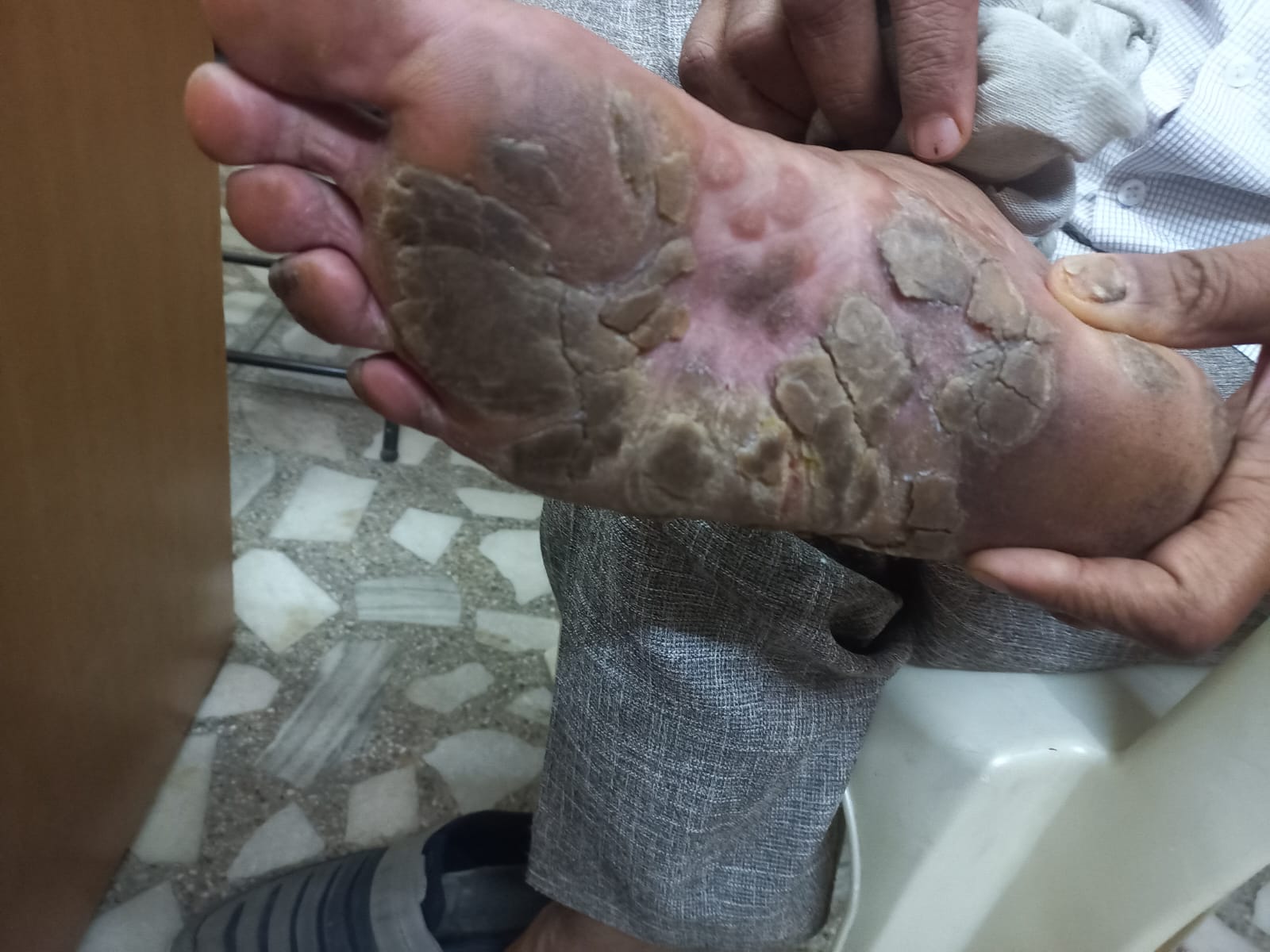 Homoeopathic Treatment for Psoriasis | Natural & Long-Term Relief in Delhi